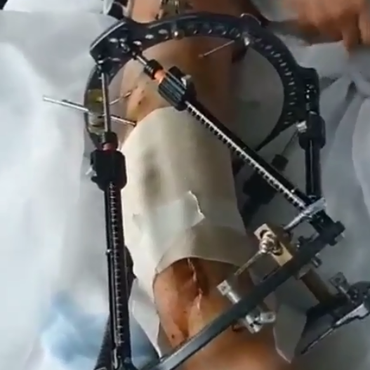 بالفيديو - نجل فنانة خليجية يخضع لتركيب جهاز طبي بعد 21 عاماً من العمليات الفاشلة