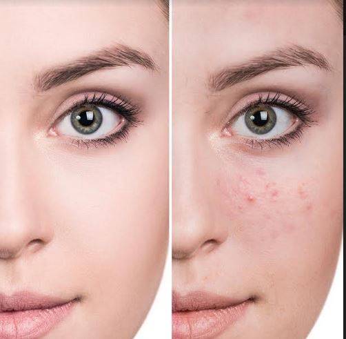 تخلصي من حب الشباب قبل العيد