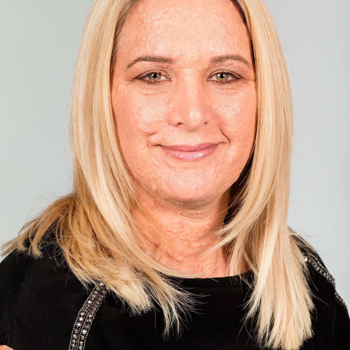 تعاني من مرض غريب... آلاف البثور تنمو على بشرتها وتعرضها للتنمر