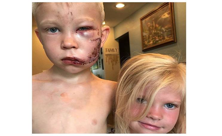 نجوم العالم يواصلون دعم الطفل الذي تصدى لكلب شرس دفاعا عن شقيقته