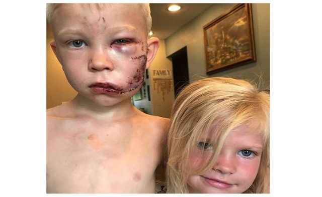 نجوم العالم يواصلون دعم الطفل الذي تصدى لكلب شرس دفاعا عن شقيقته