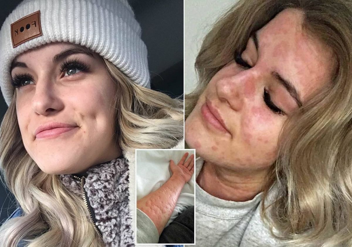 تعيش في كندا وتعاني من حساسية البرد النادرة وهذه أعراضها