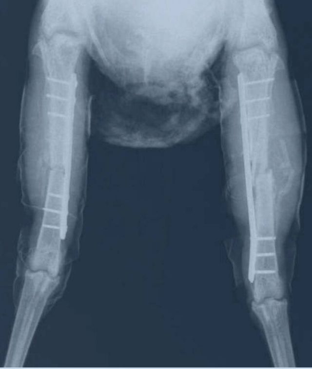 قدما الفرخة ليسكي بالأشعة