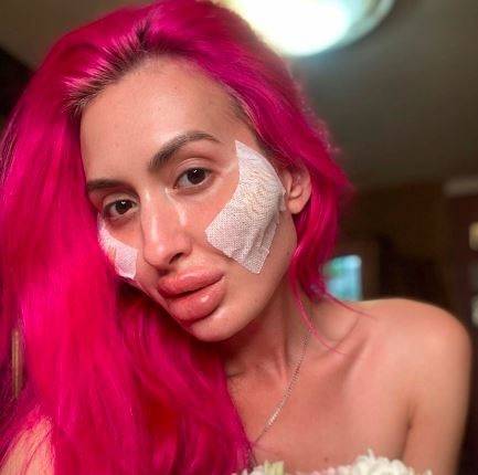 تعرّفوا على صاحبة الوجنتين الأكبر في العالم والمدمنة على عمليات التجميل