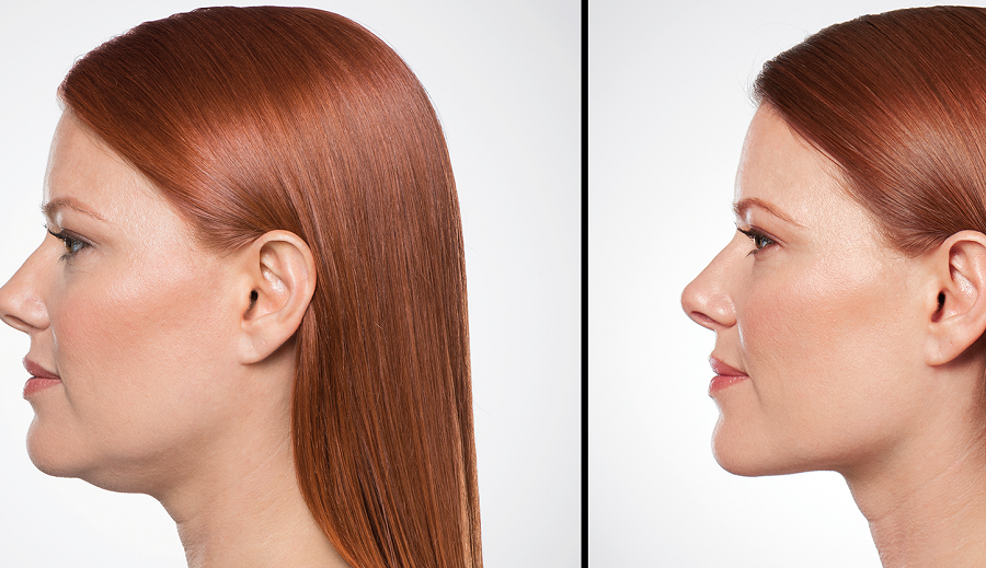 إليك طريقة التخلص من الذقن المزدوجة بالشاي الأخضر