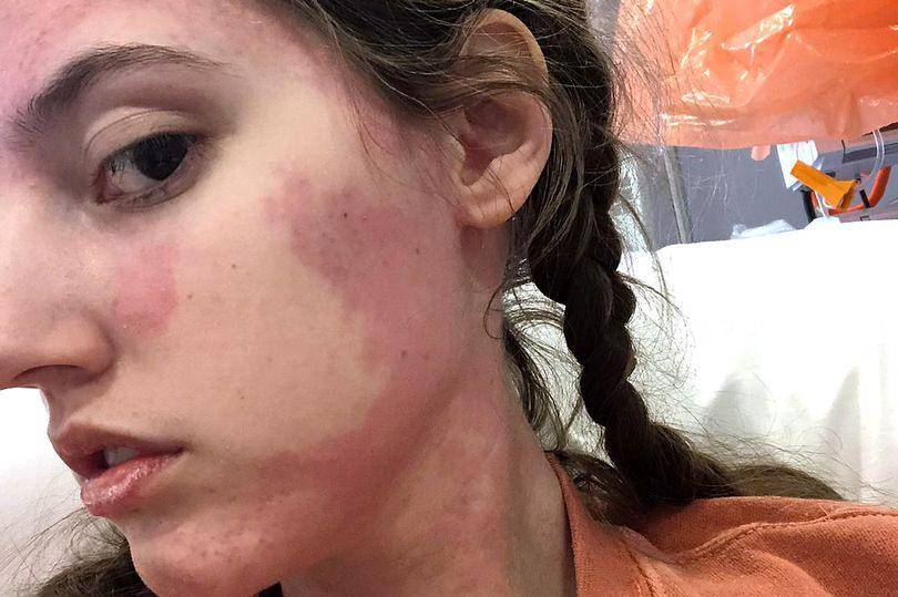 عانت من حساسية الطعام المفرطة وخسرتِ 30 كيلوغراماً... إليكِ تفاصيل الحالة الغريبة