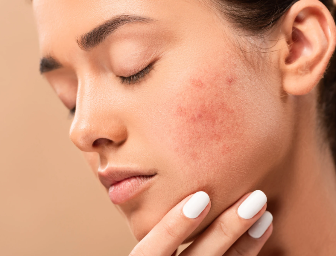 هل تخفين البثور بالمكياج؟ إليك الخطأ الذي يجعلها تكبر