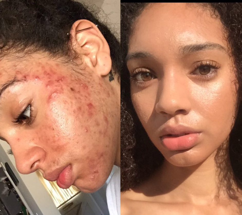 تخلّصت من حَبّ الشباب في أقل من شهر بـ5 مراحل