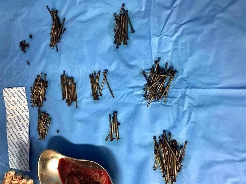 ظاهرة غريبة - استخراج مئات المسامير من معدة مريض في السعودية