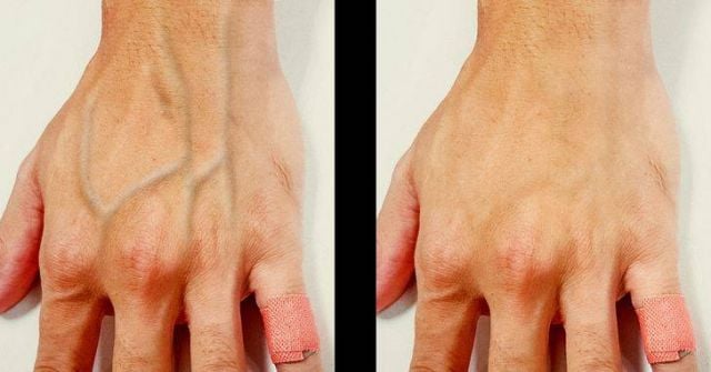 بروز الأوردة ظاهرة عادية أم مرضية؟ إليك الحقيقة