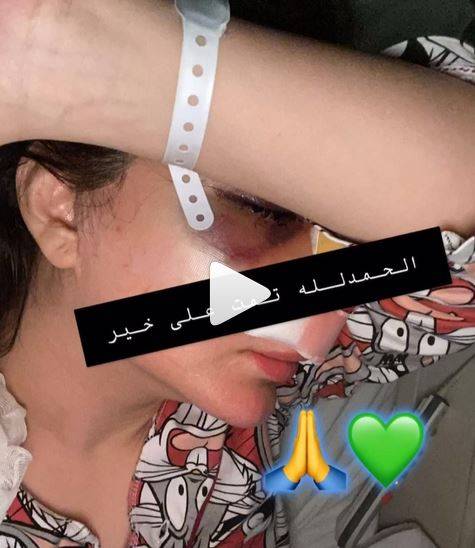 بالفيديو - فنانة خليجية تصدم الجميع بوجه متورم بعد عملية