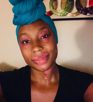 حالة نادرة وغريبة... ينسلخ جلدها مرة شهرياً وهذه قصتها