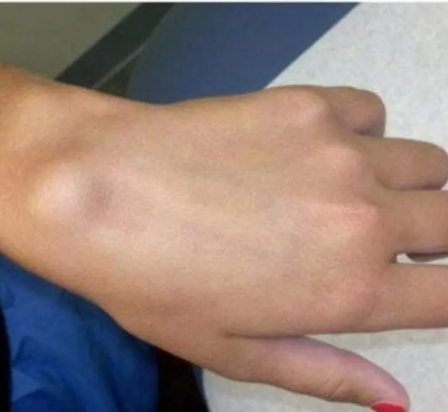 ما هذه الحدبة التي تظهر لدى الكثيرين؟ إليكم حقيقتها