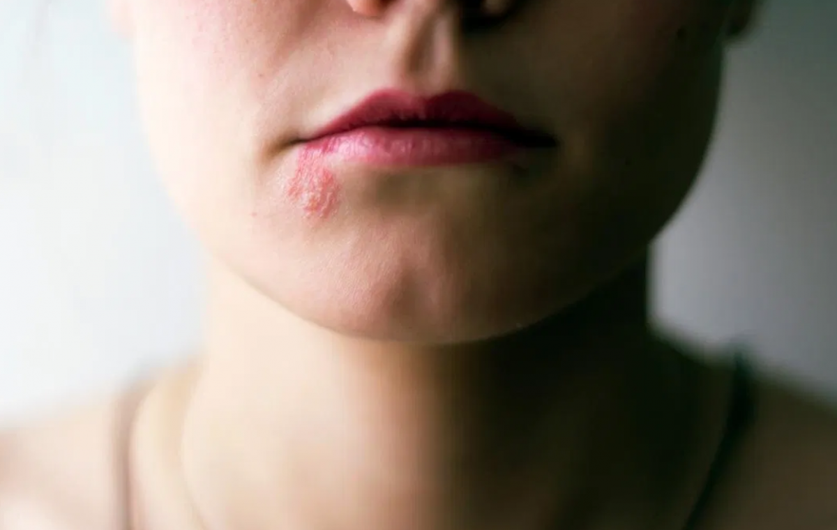 إليكم أعراض مرض زونا الغريب الذي يسبّبه التوتر