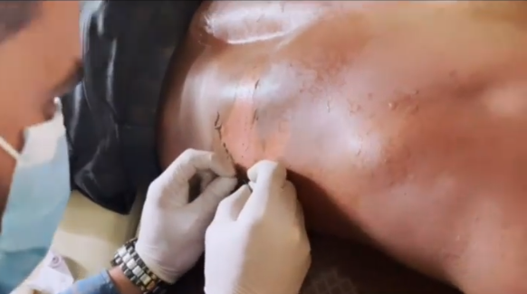 بالفيديو - محمد رمضان يُصاب بحروق بالغة في ظهره