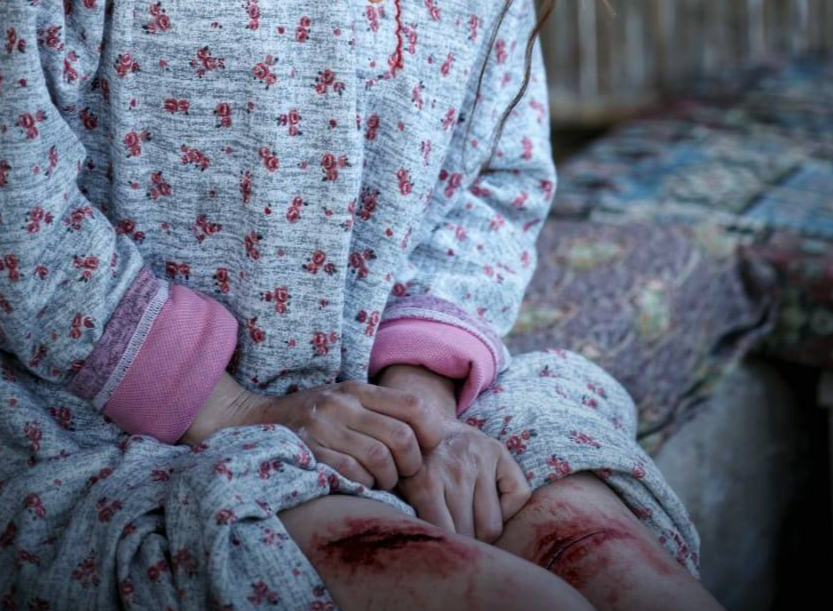 بالصور - ممثلة سوريّة شابة مصابة بجروح عميقة