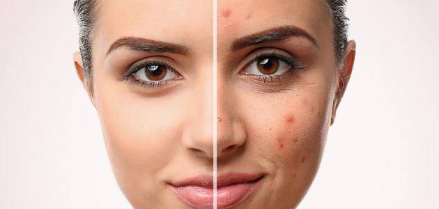 خطوات بسيطة للعناية بالبشرة الدهنية