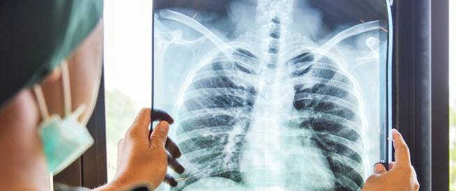 قلق بريطاني من تفشي شكل جديد من السل!