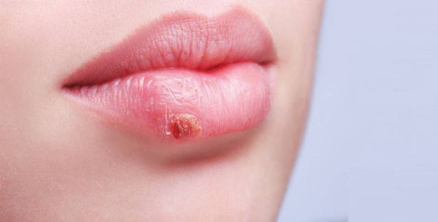 ما هو فيروس الهربس الخطِر المنتشر بعد الكورونا؟