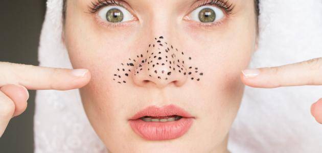 خطوات فعالة للتخلص من الرؤوس السوداء المزعجة