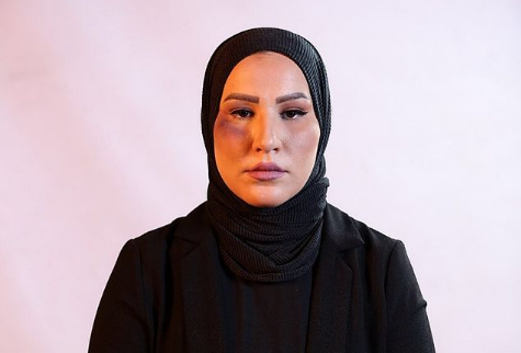 الكدمات تعلو وجه نداء شرارة... إليكم السبب