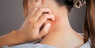 مرض حساسية الماء نادر ومزعج... احذري منه