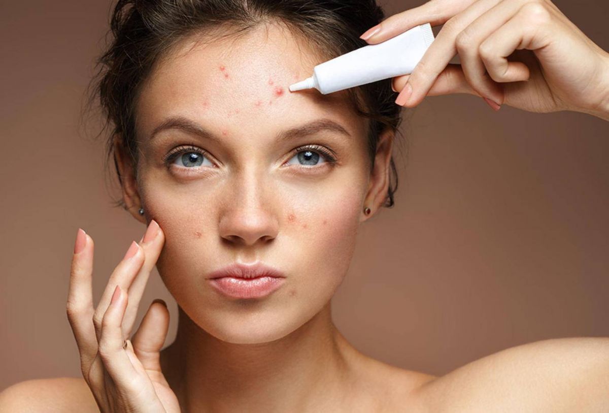 هذه المعلومات غير صحيحة عن أسباب حَبّ الشباب