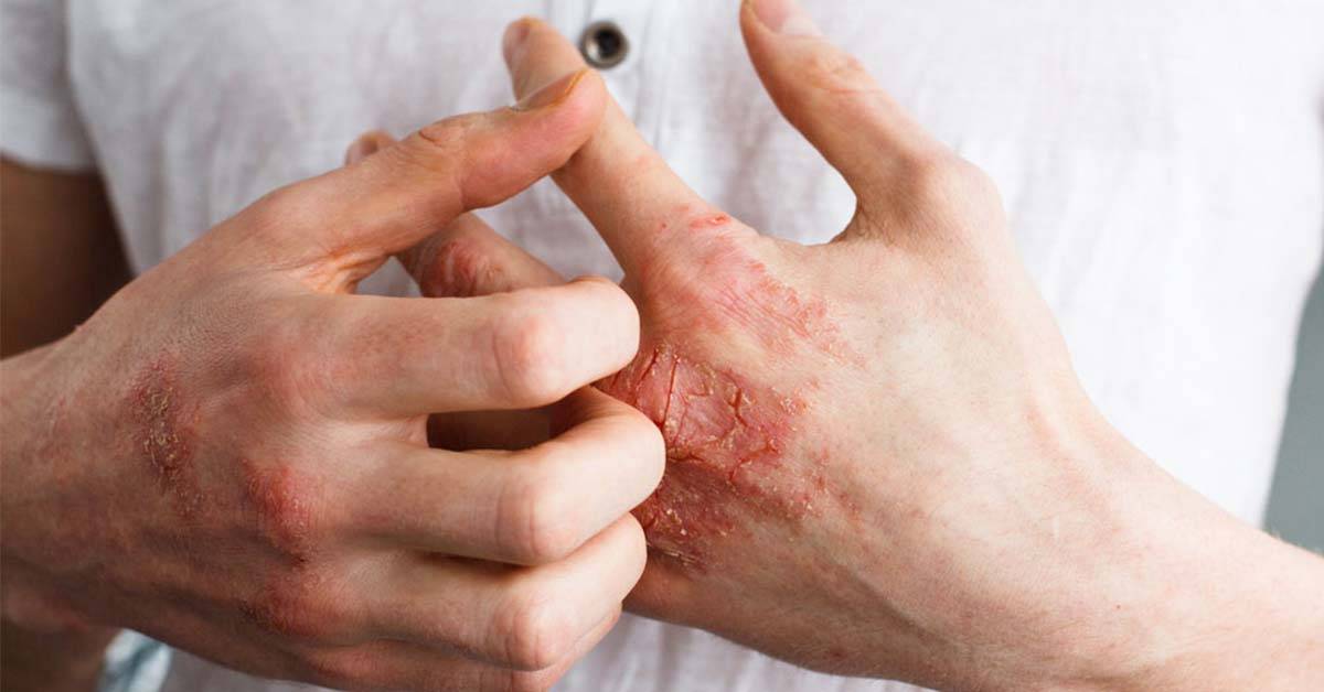 أطعمة تخفّف من أعراض الأكزيما المزعجة