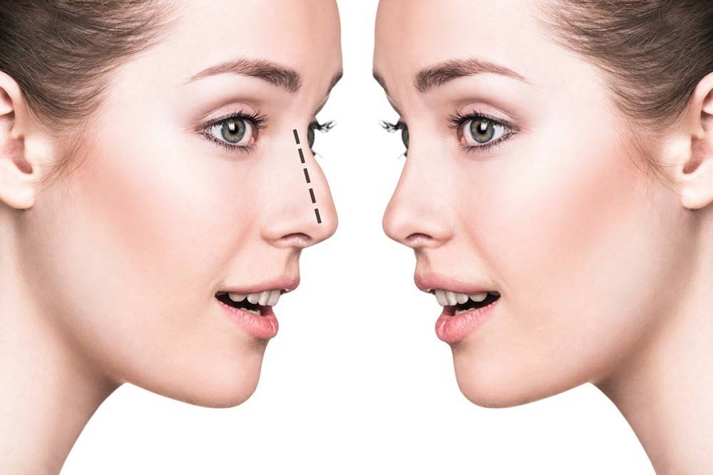 تعرفي إلى أنواع عمليات تجميل الأنف