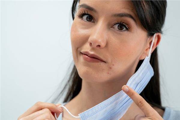 حلّ بسيط لعلاج البثور الناتجة عن ارتداء الكمامة