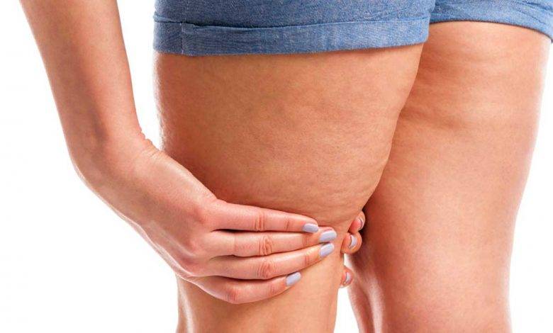 3 طرق منزلية سهلة للتخلص من السيلوليت