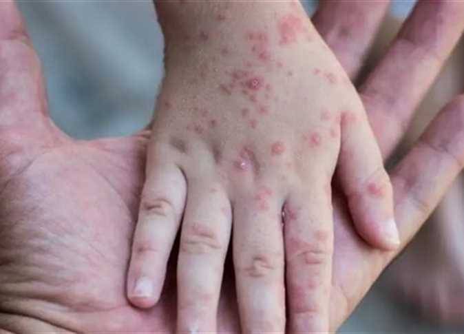 العالم يدق ناقوس الخطر بسبب جدري القرود