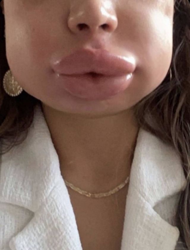 بالفيديو - فنانة مصرية توضح سبب إصابتها بتشوّه في وجهها