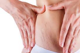 جربي هذه العلاجات البسيطة لعلاج علامات التمدد بالجسم