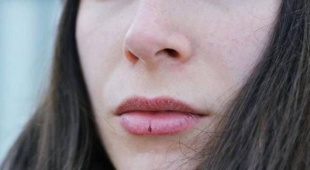 وصفات بسيطة لحماية الشفاه من التشقّقات