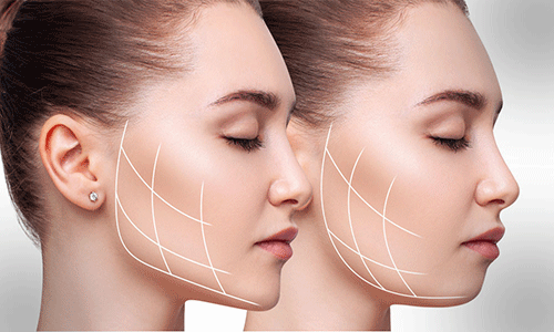 إزالة دهون الخدّين موضة رائجة في التجميل... ما هي مخاطرها؟