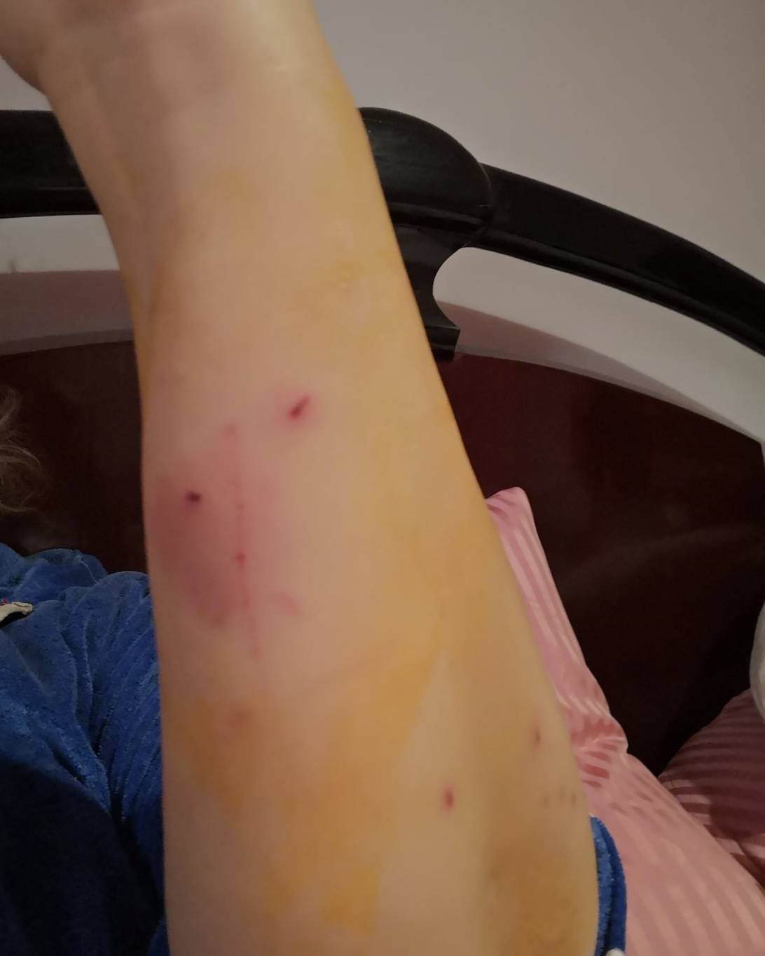 إصابة منى إش إش  