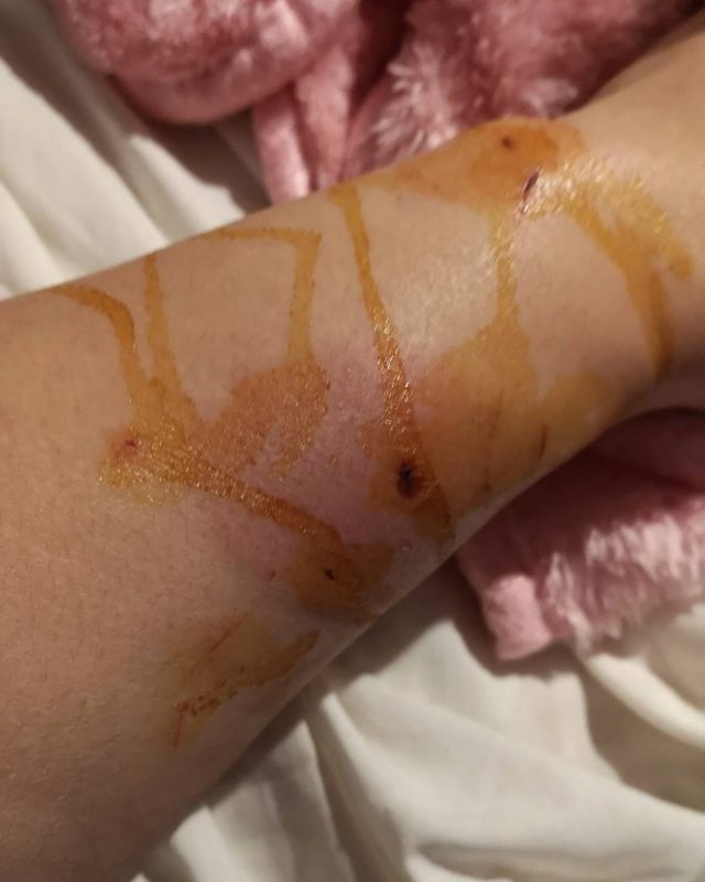 إصابة منى إش إش  