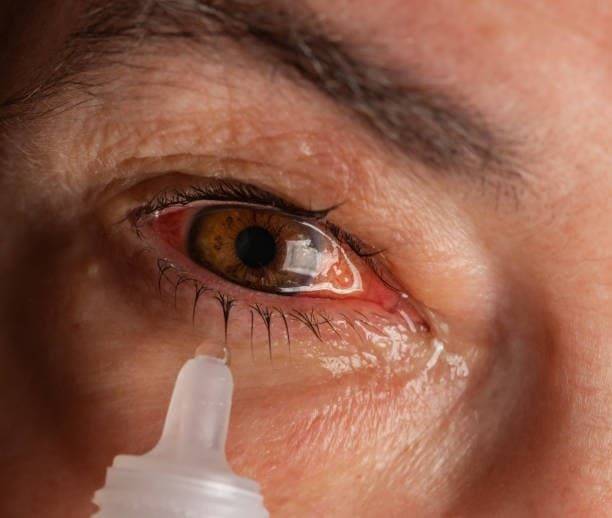 علاج بديل للقطرات اليومية لعلاج جفاف العيون