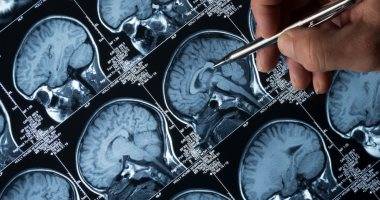 تقنية جديدة تعتمد على الموجات الصوتية لكشف الألزهايمر