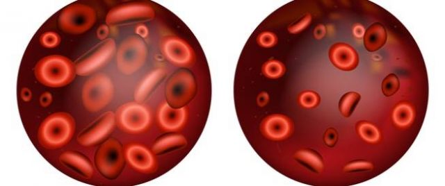 توصيات لمرضى فقر الدم خلال الصوم