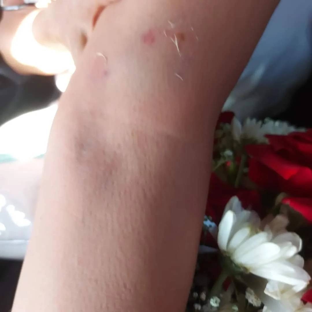 آثار العض على يد مادلين طبر 