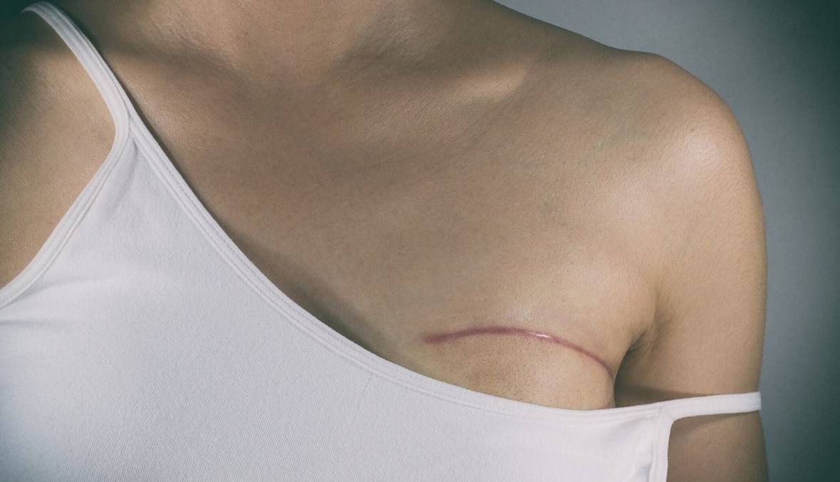 ترميم الثدي الحلّ الأنسب لإعادة الثقة الى مريضة السرطان