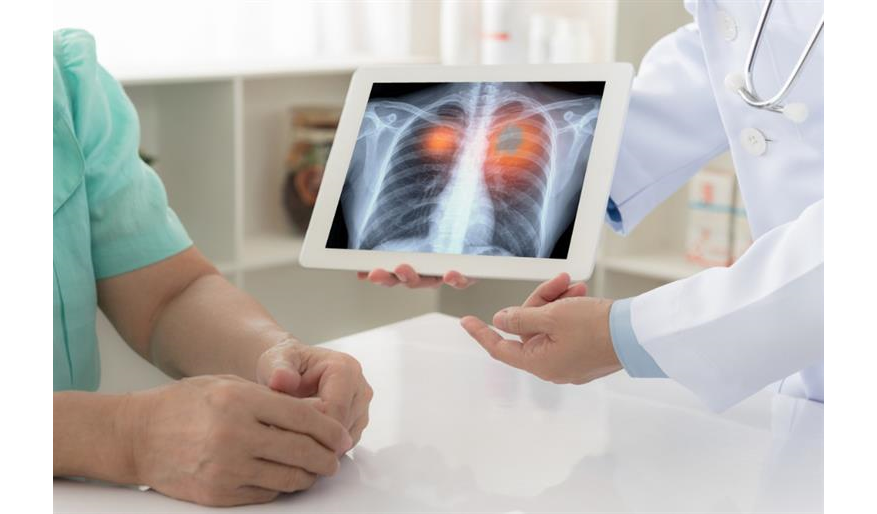 هيئة الغذاء والدواء الأميركية تكشف عن علاج جديد لسرطان الرئة