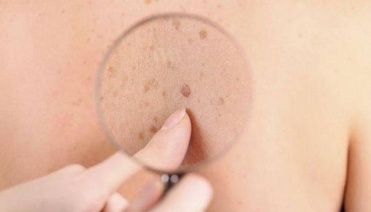 الطبيب خالد النعيمي يتحدث عن دور الذكاء الاصطناعي في تشخيص الأمراض الجلدية