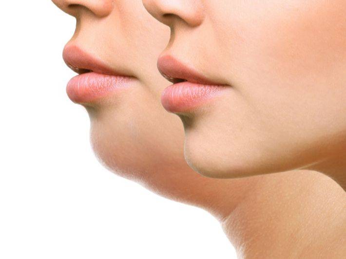 طرق غير جراحية للتخلص من الذقن المزدوج المزعج