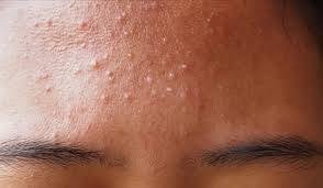 بثور الجبهة المزعجة.. أسباب ظهورها وطرق علاجها