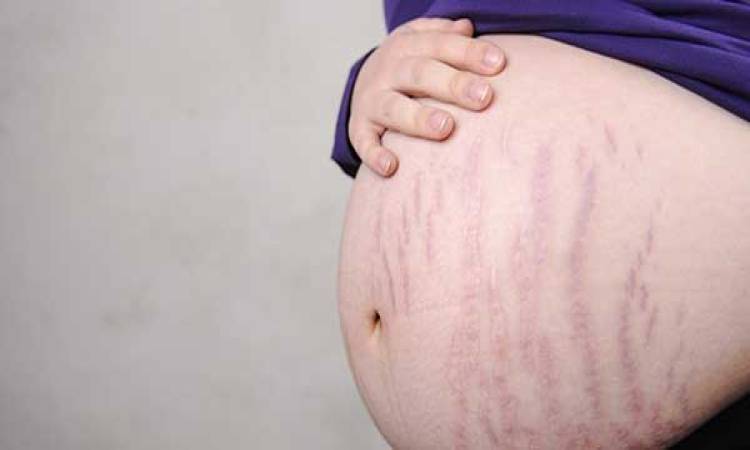 أفضل الطرق الطبيعية للتخفيف من ظهور تشقّقات الجلد المزعجة