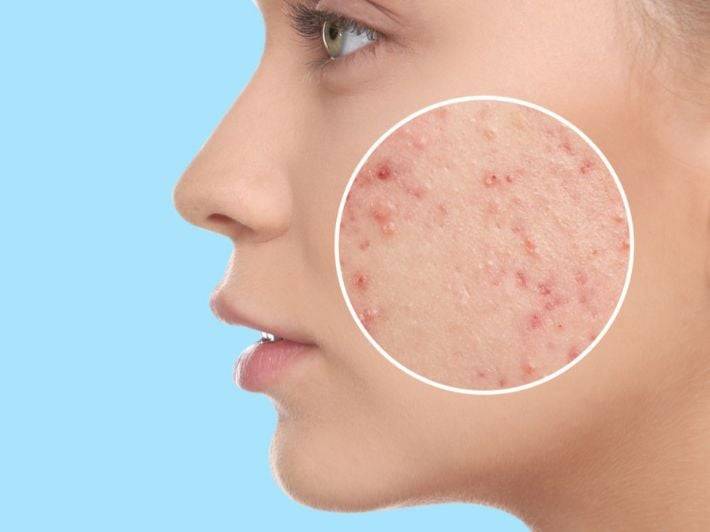 تطوير علاج موضعي غريب لمشكلة حَبّ الشباب