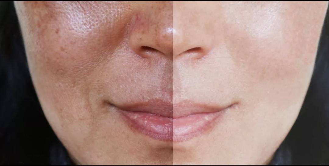 طرق للحدّ من ظهور الكلف مع التقدّم في السنّ